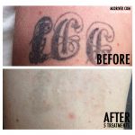 MJ Driver Laser Tattoo Removal & Lightening