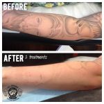 MJ Driver Laser Tattoo Removal & Lightening