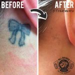 MJ Driver Laser Tattoo Removal & Lightening